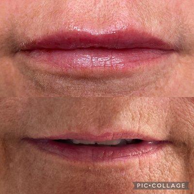 Needless lip filler