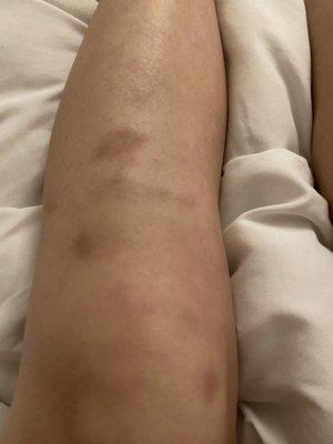 Bruises from the rough massage