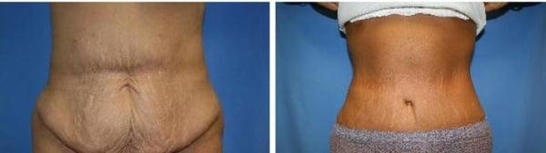 Tummy Tuck Before & After