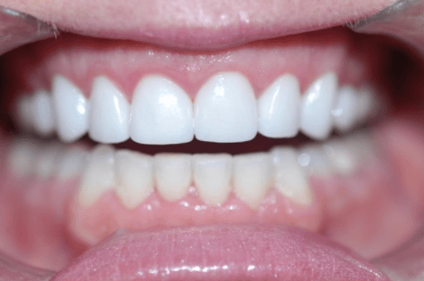 After First Choice Dental veneers