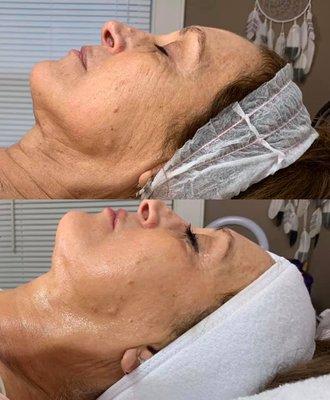 Q.Q.C.L.L.C our Cryofacials restore your natural collagen back to the surface of the skin, removing wrinkles, fine lines & signs of aging.