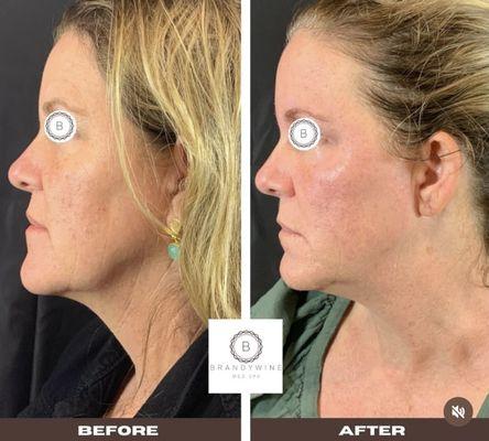 Emface non-surgical facelift results.