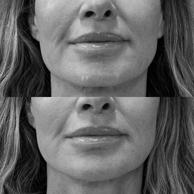 Chin filler improves facial balance and enhances natural beauty!