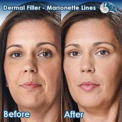 Dermal Filler: Marionette Lines - Before & After Results - Please Call (949) 313-2600