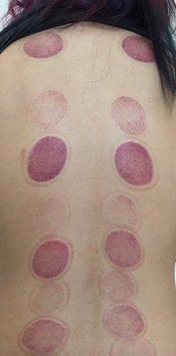 After cupping session