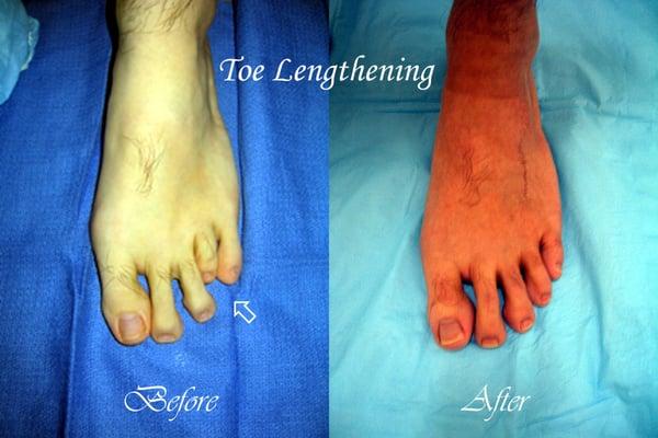 Toe Lengthening (Before & After)