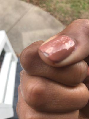 Chipped thumb