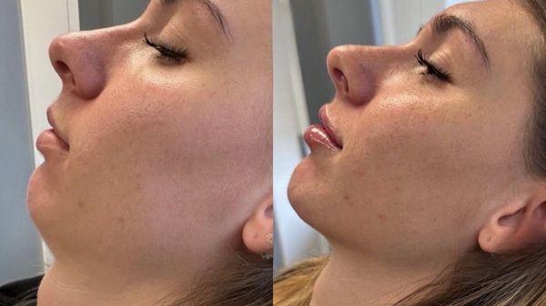 Chin filler