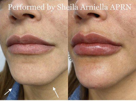 Chin and lip augmentation with dermal fillers. Performed by Sheila Arniella NP.