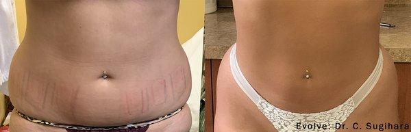 Evolve Transform
Skin Remodeling, fat treatment and muscle toning. 
Before and After