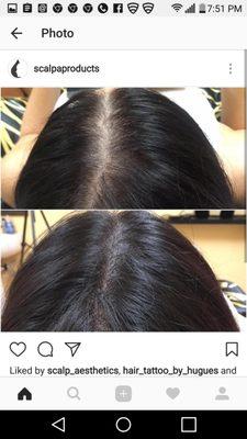 Scalp Micro Pigmentation