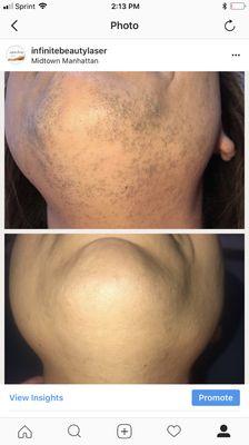 Amazing Results!  #laserhairremoval #facialhair #BAREitALL