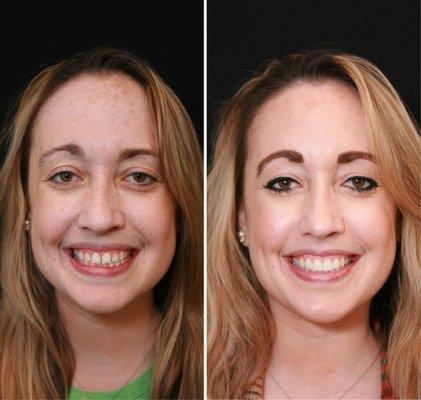 Before and After - Four Porcelain Veneers