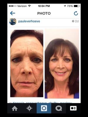 Before and after autologous facial fat grafting/transfer with Platelet Rich Plasma