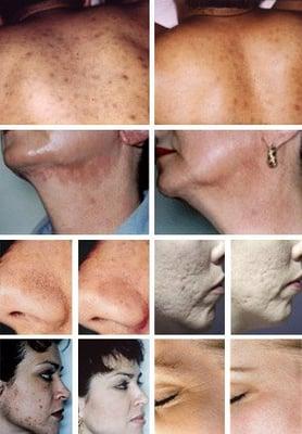 Dermaglow Microdermabrasion Treatment - remove excess oils  , Blackhead/Whitehead , Stretch Marks, Sun damaged skin, Acne scar..