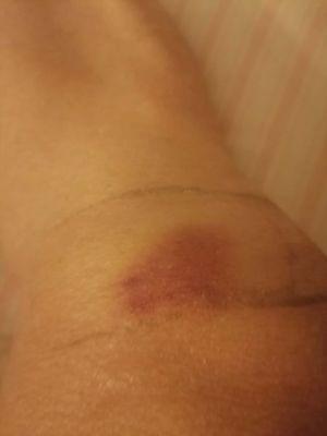 Bruise after the shot on my knees.