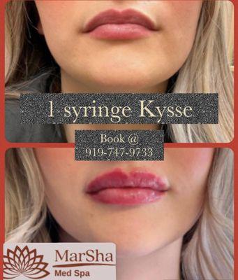 LIP FILLER SPECIAL! BUY 1 SYRINGE KYSSE , GET $100 OFF PLUS 50 UNITS FREE DYSPORT!