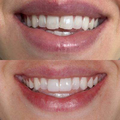 Fixing alignment and chipping of the 2 front teeth with Veneers