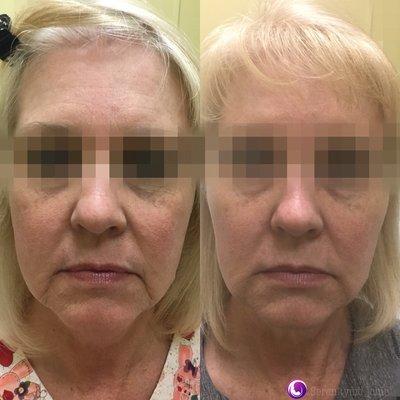 Juvederm for softening of marionette, tear trough, nasolabial folds (parentheses) and vertical lip lines