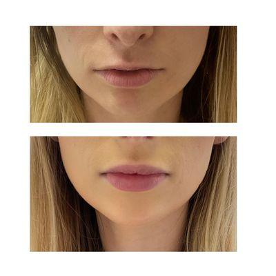 Before and after. Lip flip and filler.