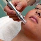 Microdermabrasion