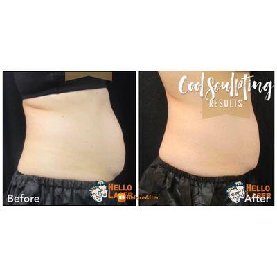 CoolSculpting results, fat removal, noninvasive fat reduction, abdomen fat removal, body sculpting.