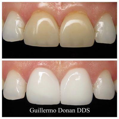 Cosmetic Dentistry, Dental Veneers can restore the look of discolored teeth to a more natural and youthful smile. Call us  559 2229923