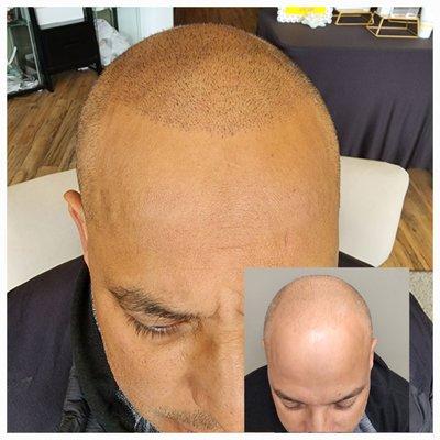 Hairline Restoration