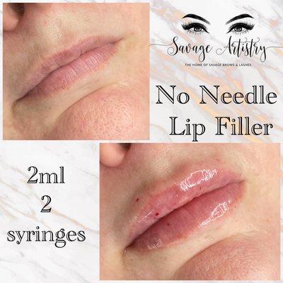 No Needle Lip Filler