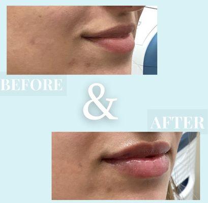 Lip injections can be an amazing improvement without overdoing it.