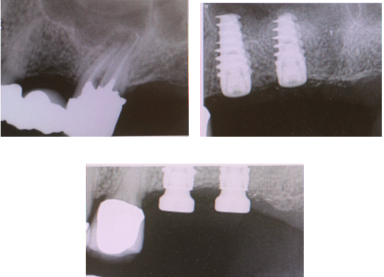 Failing bridge...replaced by implants and sinus lift