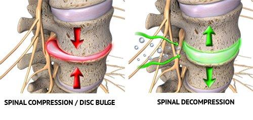 Sciatica Decompression Treatment