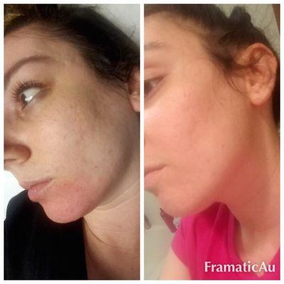 Before and after microneedling. Pores minimized, wrinkles reduced and even texture.