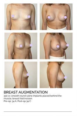 Breast Augmentation