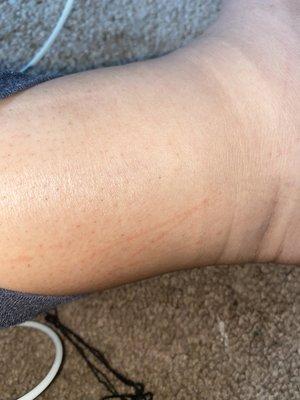 Scratches left by the buffer used on my ankles.