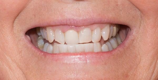 Post Zoom Whitening by Dr. Lundgren's Assistant Emily. Excellent work!