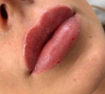 Lips filler