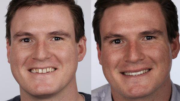 Smile Makeover with porcelain crowns, just in time for the wedding!