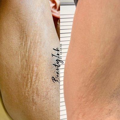 Stretch Mark Removal