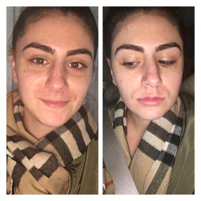 Before and after juvederm