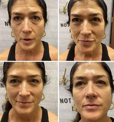 Viora Reaction Skin tightening top pics before &after 
Bottom- after Face Lift Massage