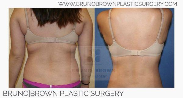 SmartLipo results on a patients flanks