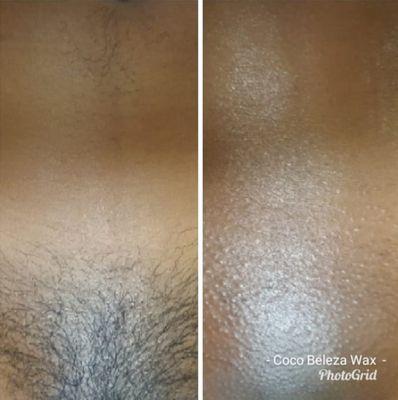 Before & After Brazilian Wax. Online booking ava from your phone using the Vagaro App, or using your desk/laptop at www.cocobeleza.com.