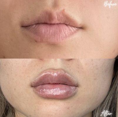 Lip fillers