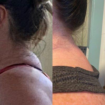 Upper back/neck before and after comparison.