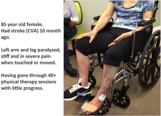 Strokes BEFORE: paralyzed left arm and leg for 10 months; in pain and immobile thru 40 sessions of physical therapy