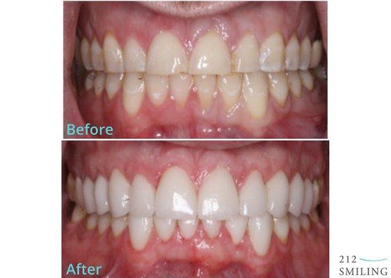 Before and After Veneers - https://www.212smiling.com/cosmetic-dentistry/porcelain-dental-veneers/