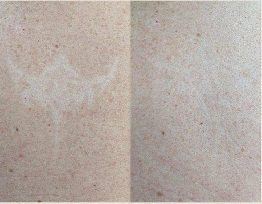 Hypopigmentation (pigment loss due to tattoo removal) camouflage