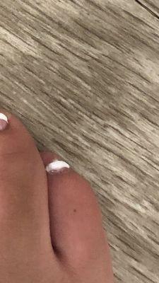 Bad pedicure