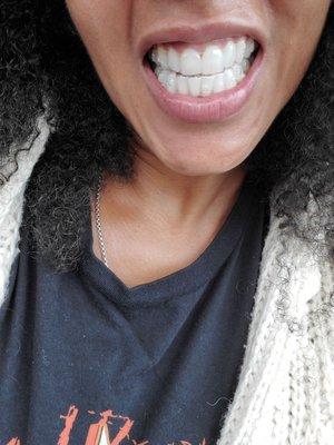 After first set of invisalign trays. 9 more movements to go.